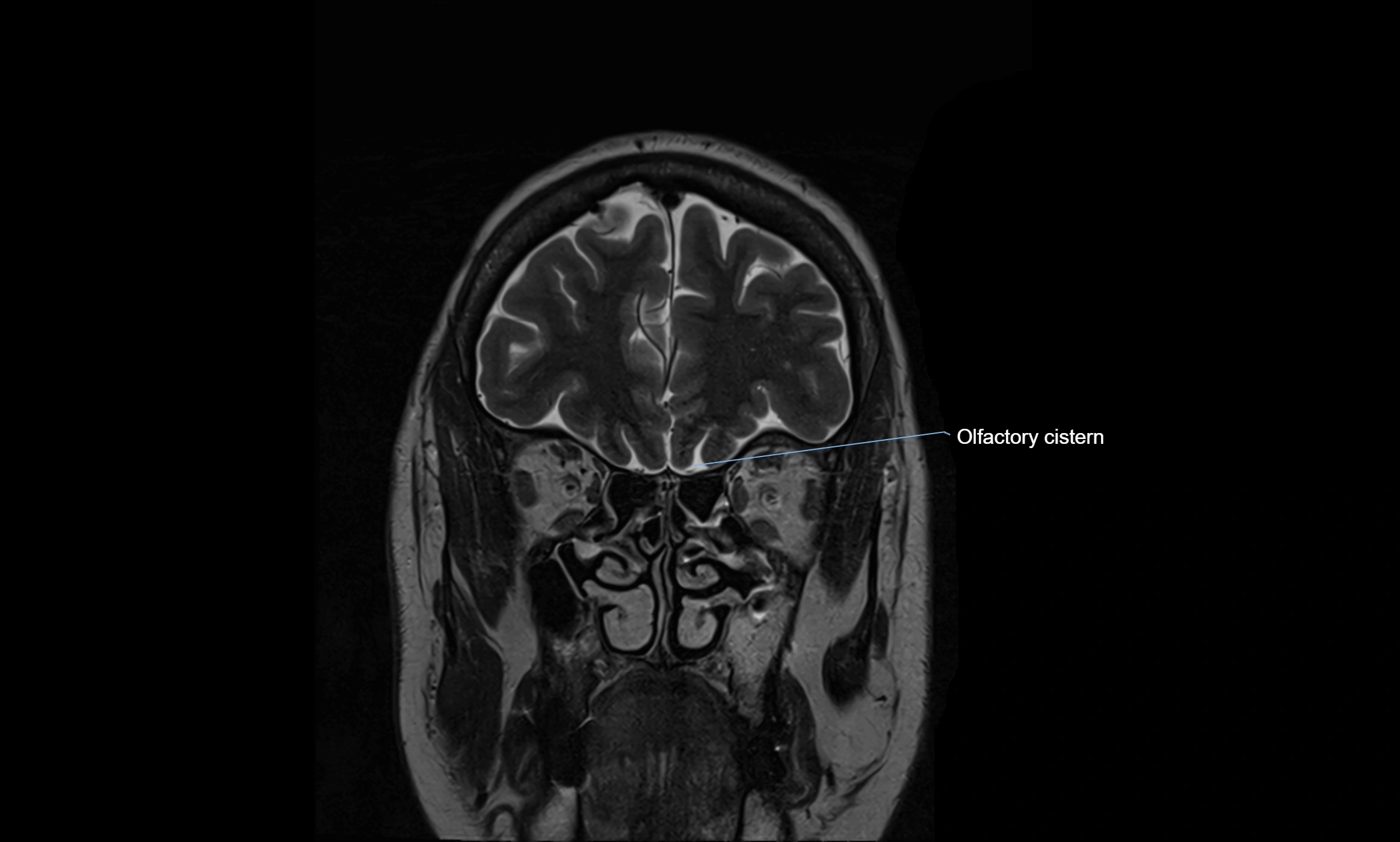 Brain cisterns  and ventricles coronal anatomy 3T MRI image-img-00001-00008.webp